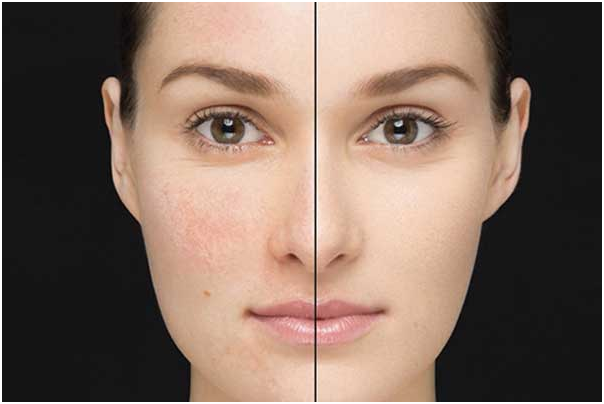 تصویری از پوست قبل و بعد از استفاده از کرم های فوراور